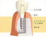 インプラント